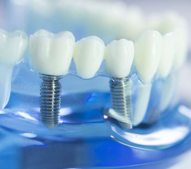 Fair Oaks Dental Implants